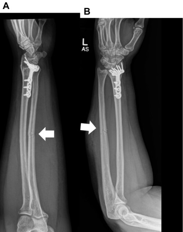 ulna.jpg